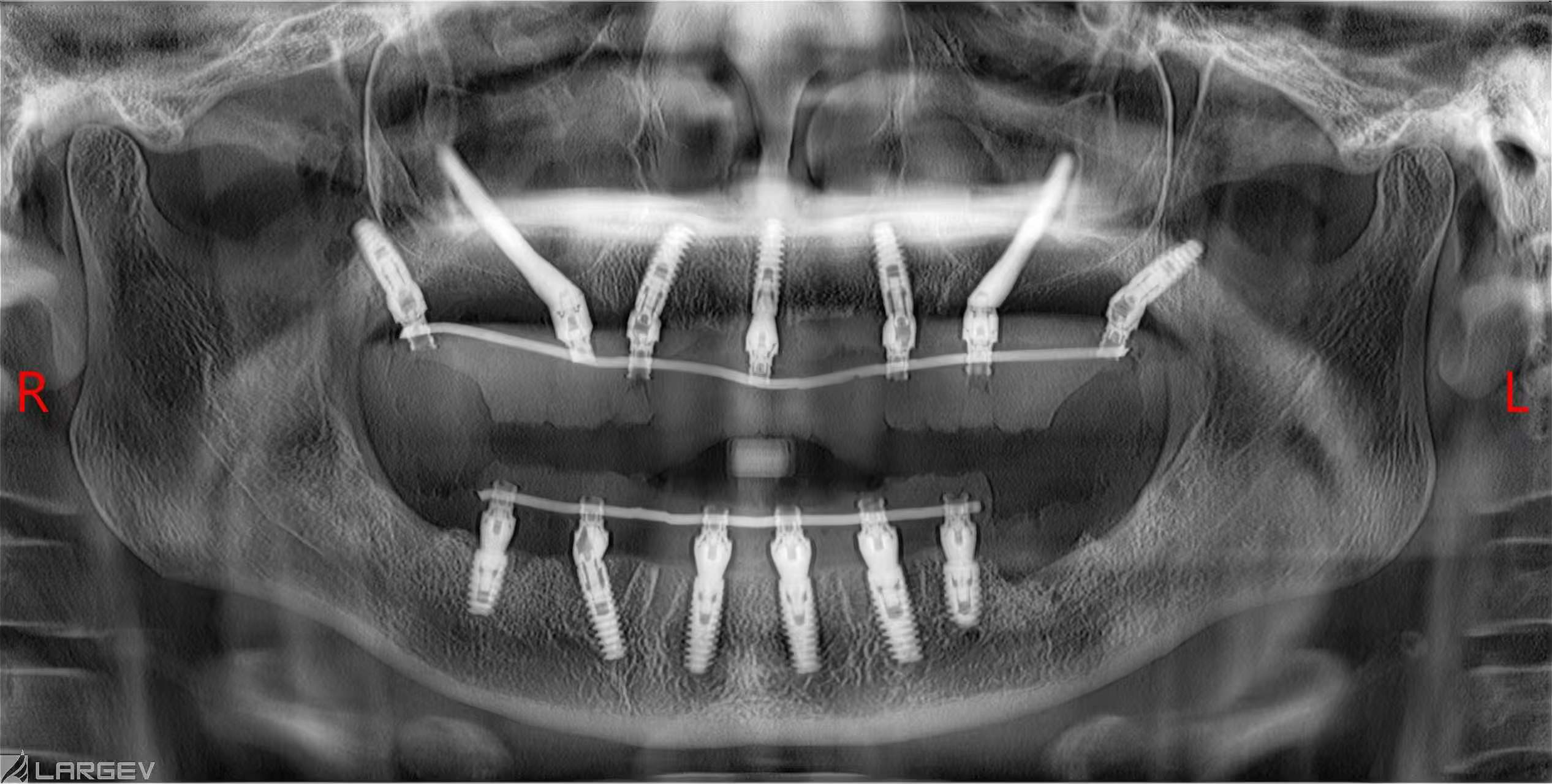 Panoramic radiograph showing upper and lower full-arch implant rehabilitation