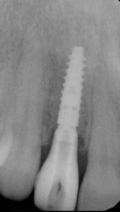 Dental radiograph showing a single implant restoration
