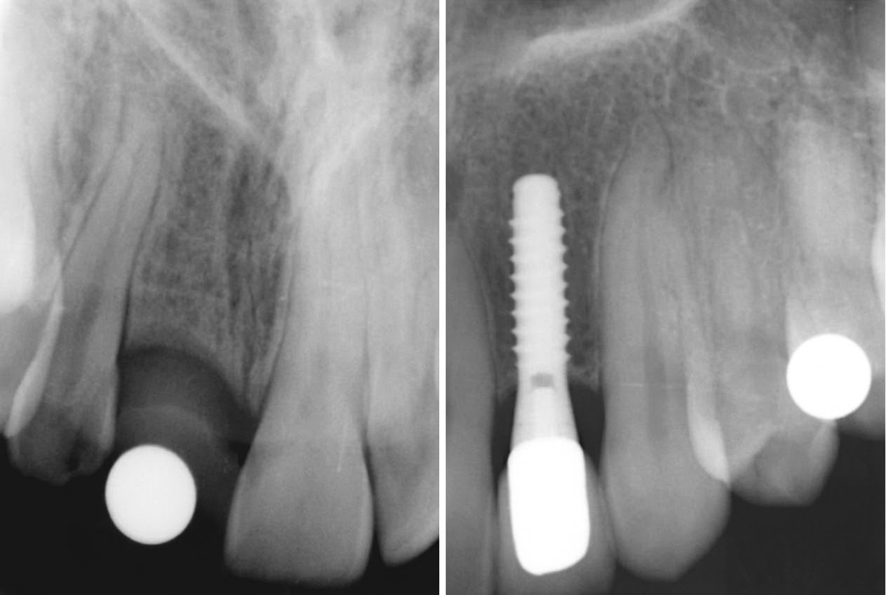 Paired dental radiographs showing a natural tooth area and a single implant example