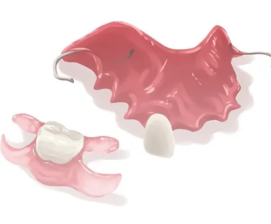 Illustration of removable partial dentures with clasps